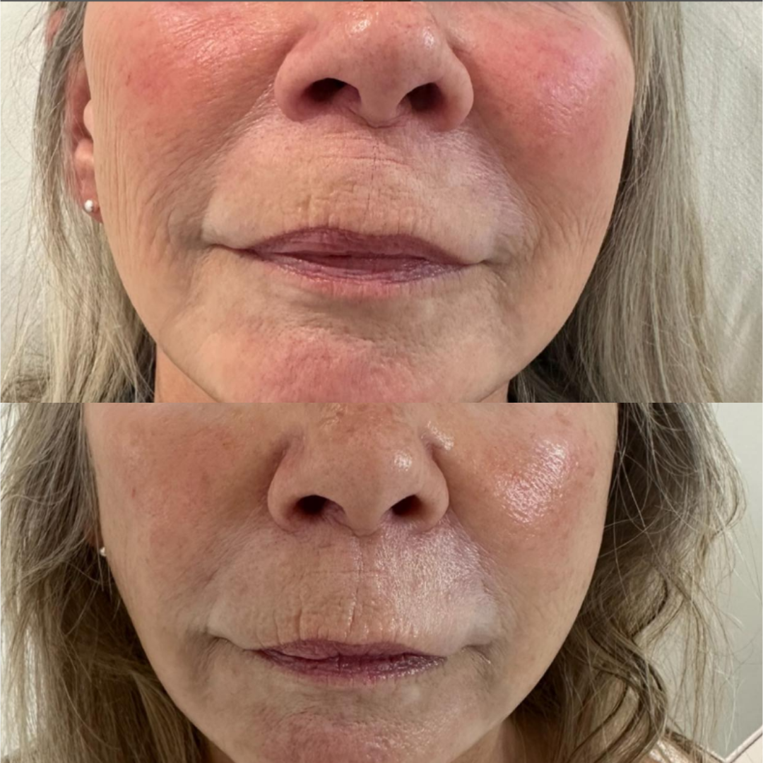 Derma Pro Fusion before and after result 1