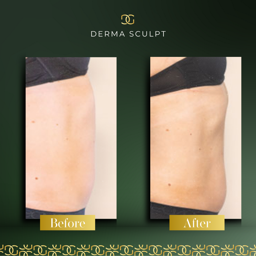 Derma Pro Fusion before and after result 4