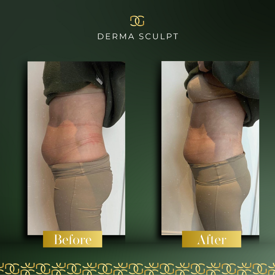 Derma Pro Fusion before and after result 4
