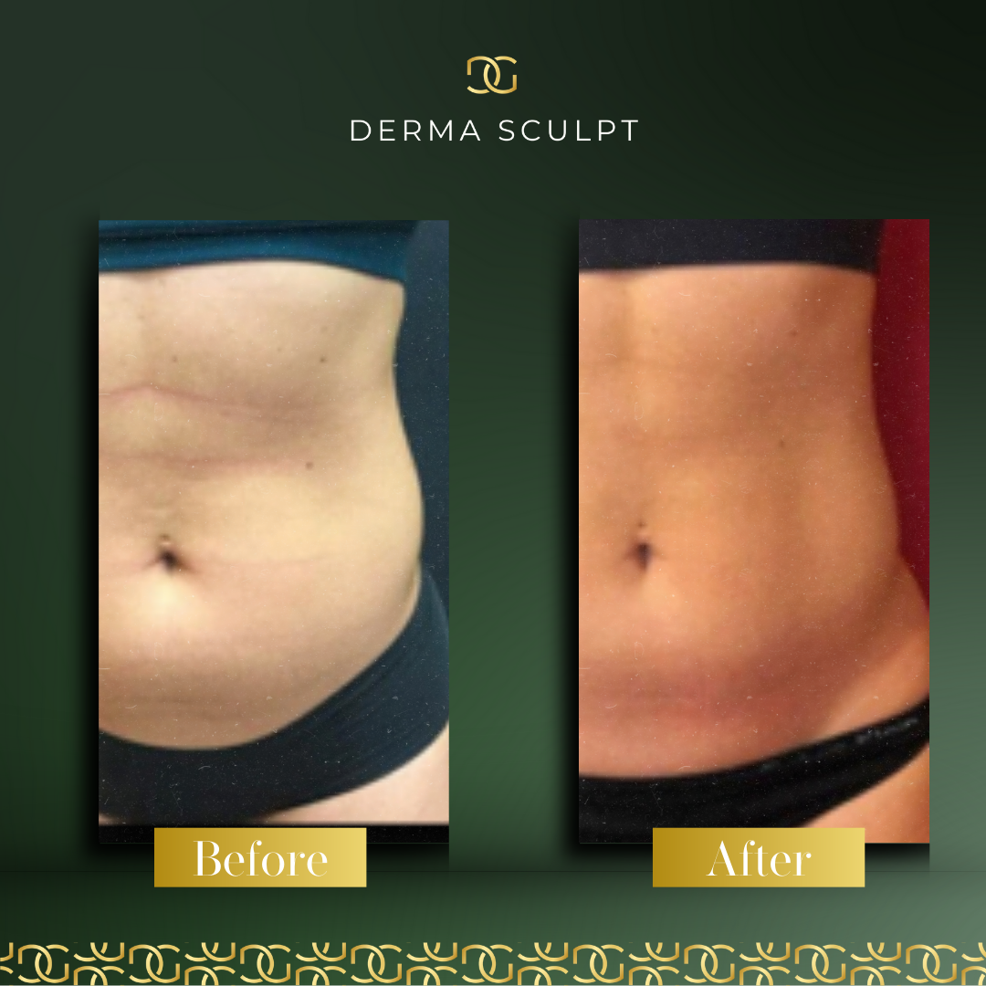 Derma Pro Fusion before and after result 4