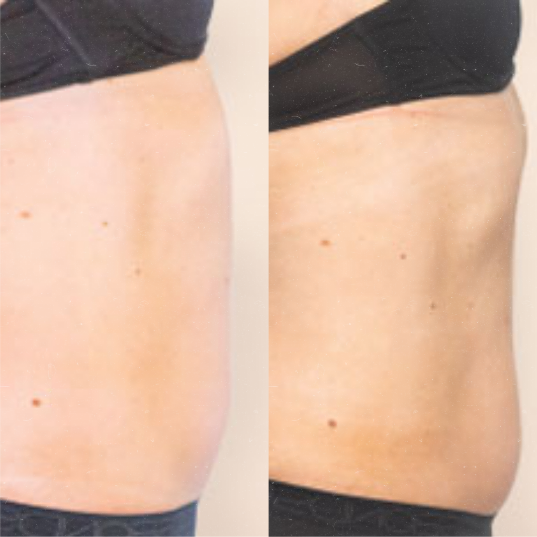 Derma Pro Fusion before and after result 3