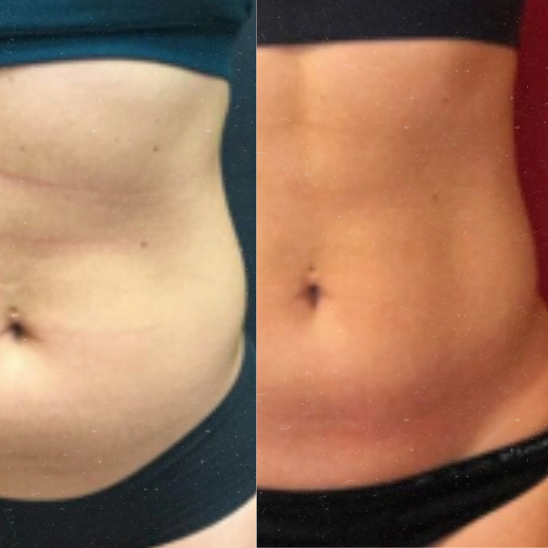 Derma Pro Fusion before and after result 2