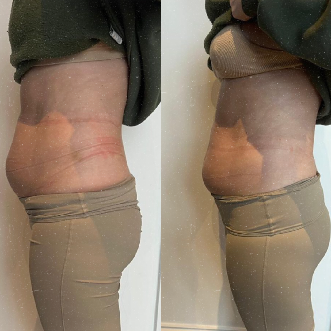 Derma Pro Fusion before and after result 1