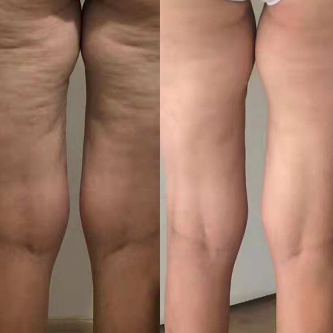 Derma Pro Fusion before and after result 3