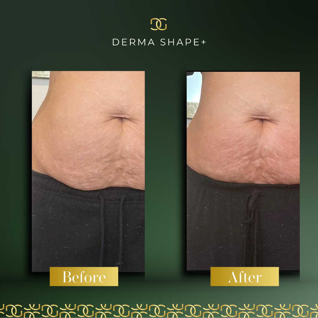 Derma Pro Fusion before and after result 4