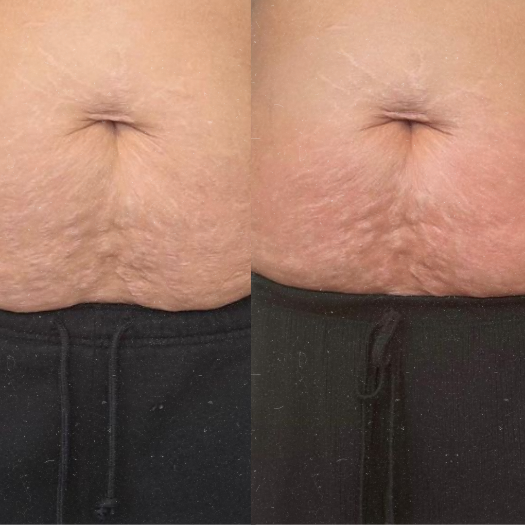 Derma Pro Fusion before and after result 4
