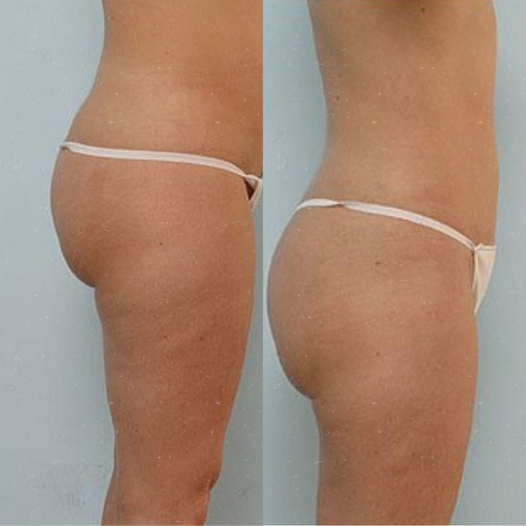 Derma Pro Fusion before and after result 4