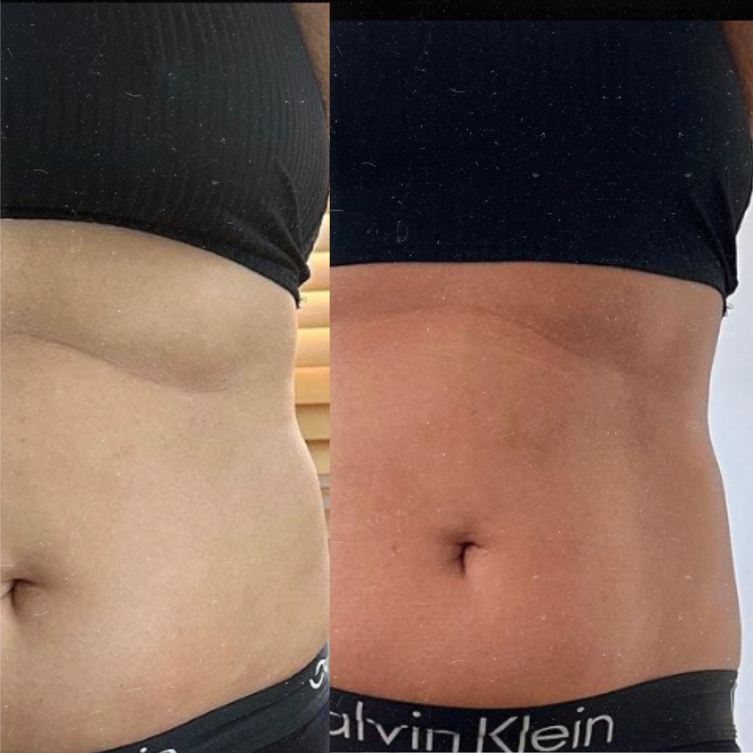 Derma Pro Fusion before and after result 4