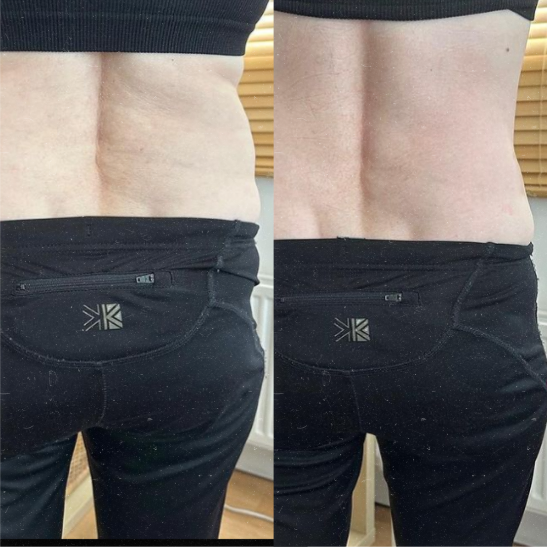 Derma Pro Fusion before and after result 4