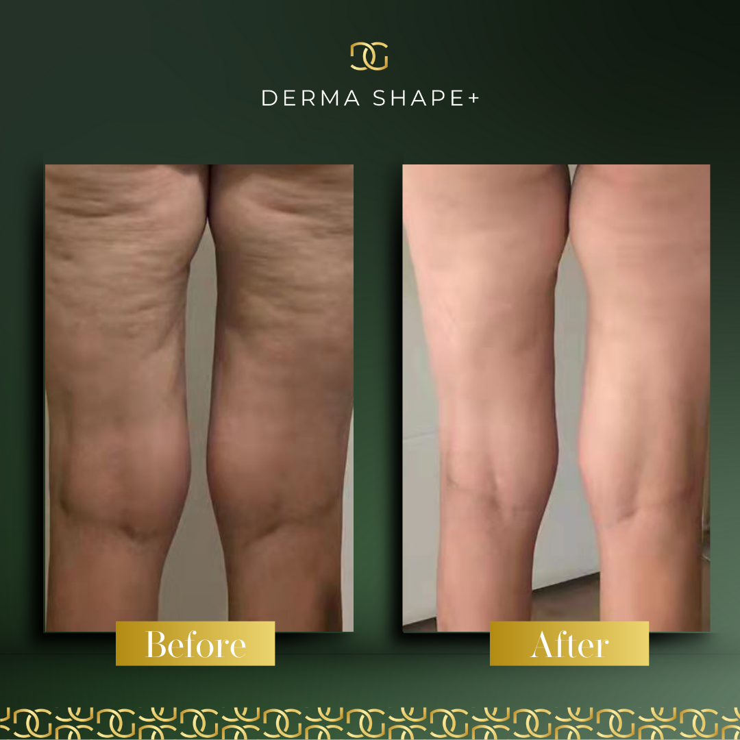 Derma Pro Fusion before and after result 4