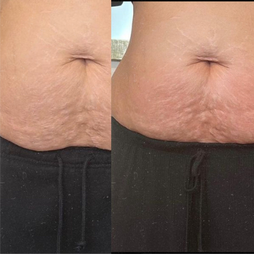 Derma Pro Fusion before and after result 3