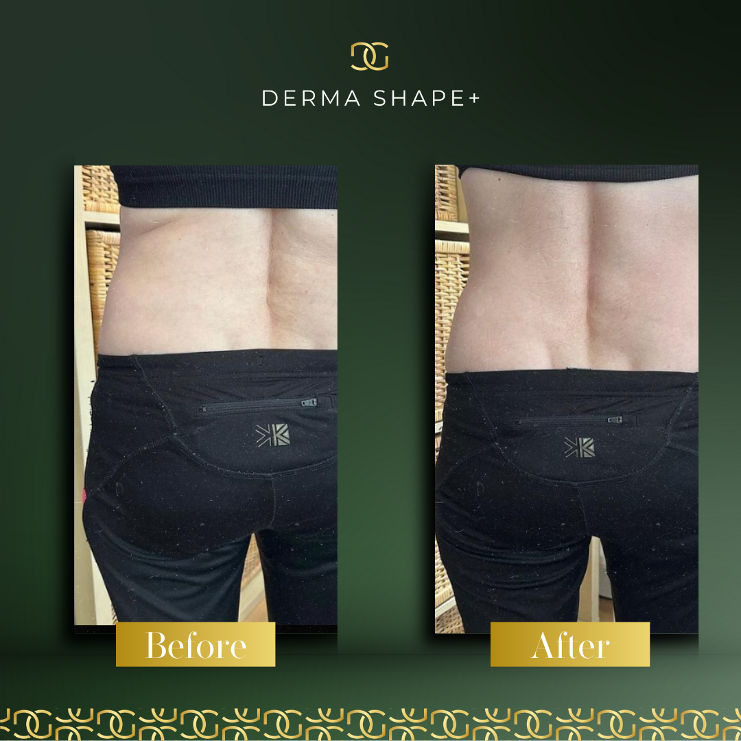 Derma Pro Fusion before and after result 2