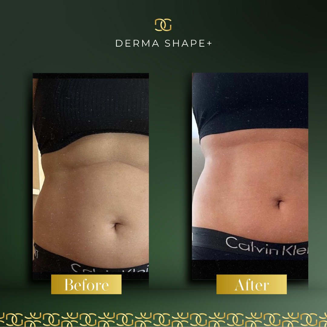 Derma Pro Fusion before and after result 1