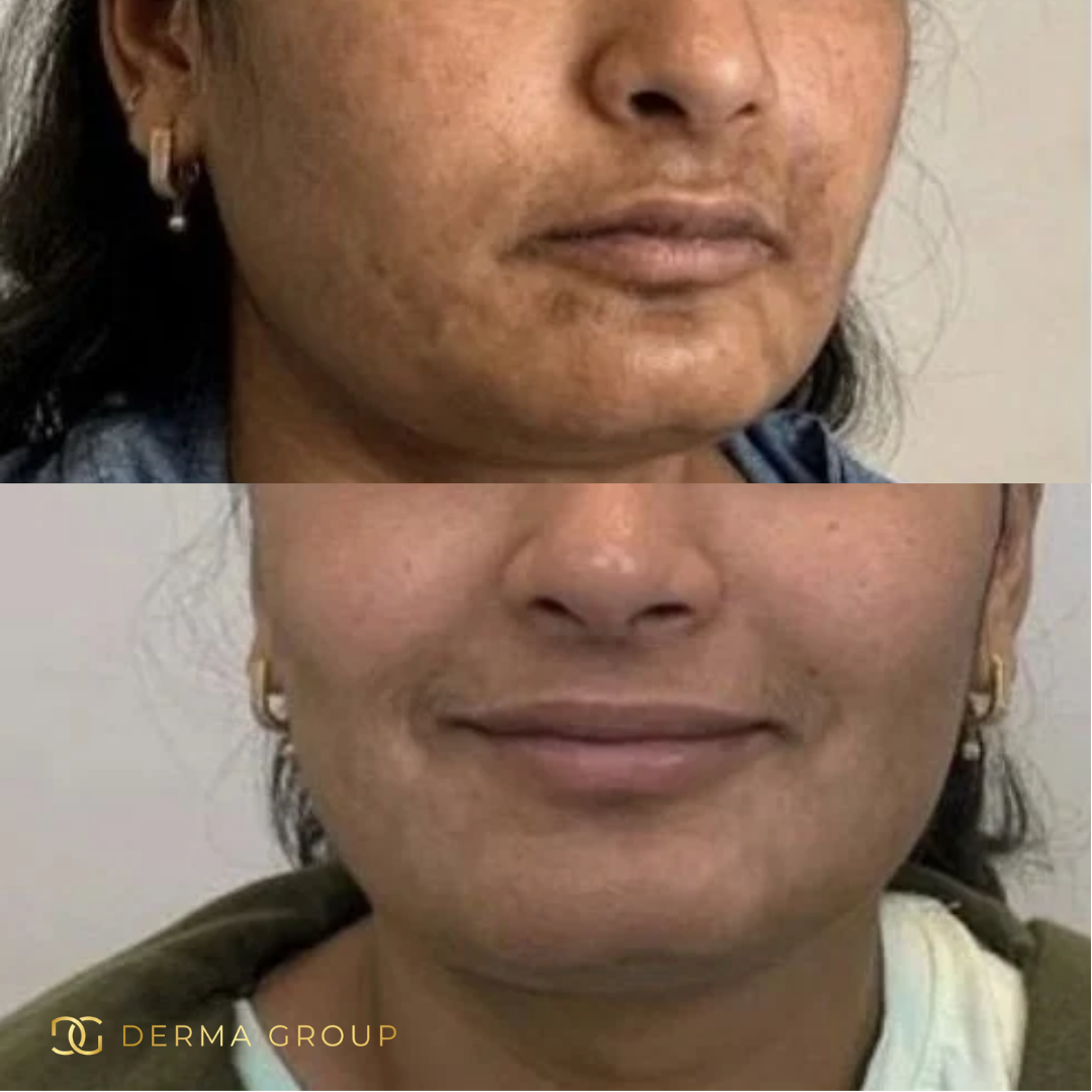 Derma Pro Fusion before and after result 1