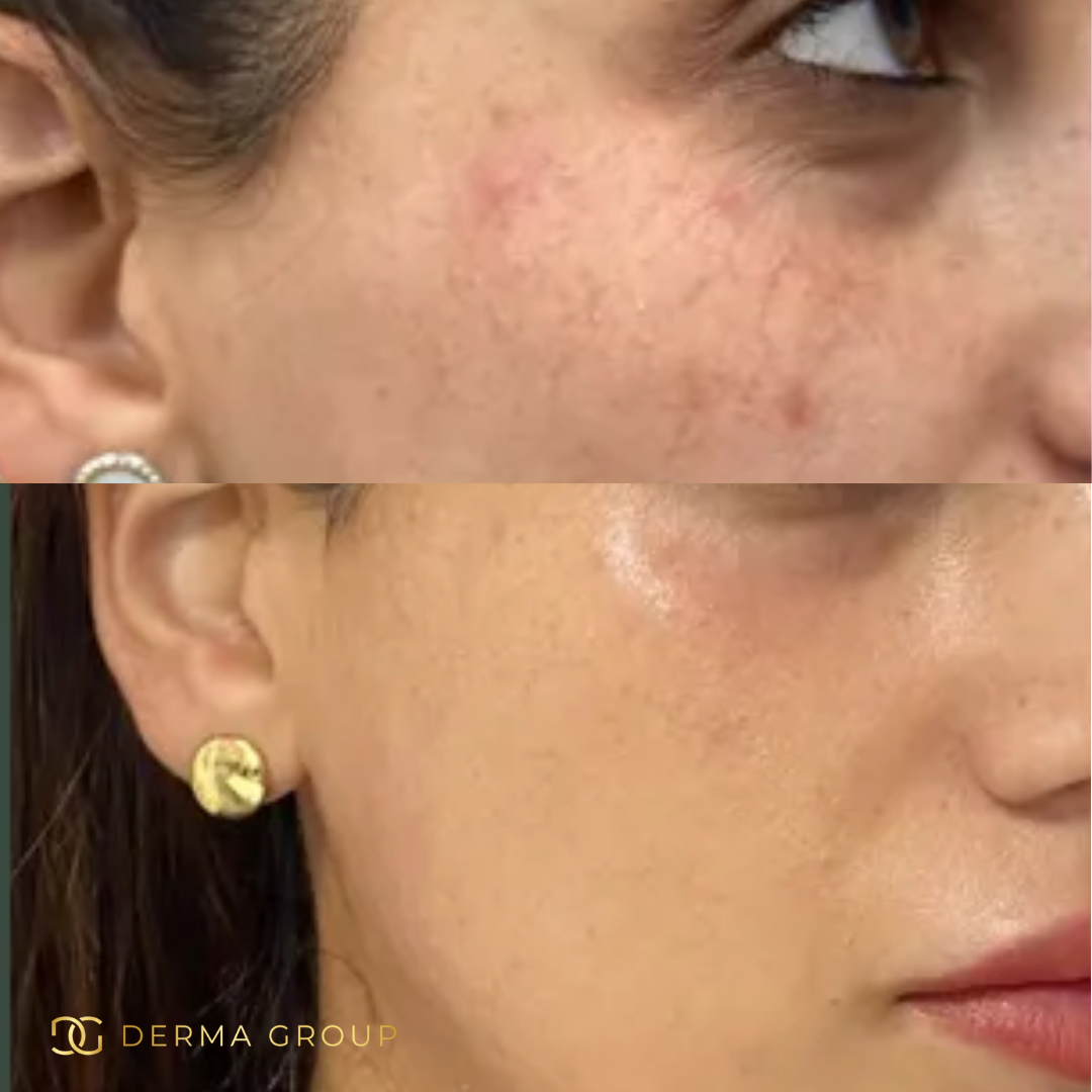 Derma Pro Fusion before and after result 4