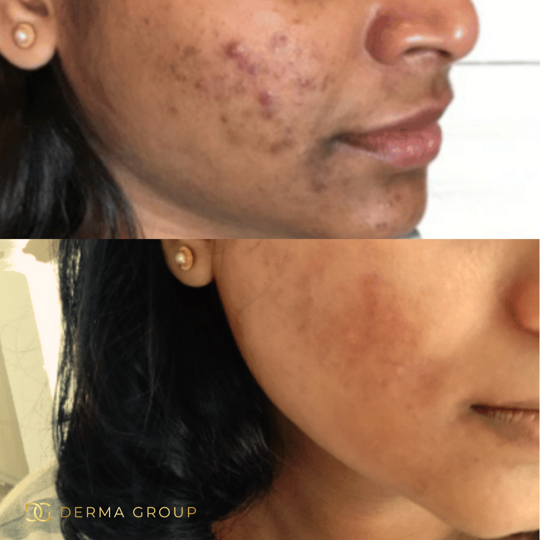 Derma Pro Fusion before and after result 2