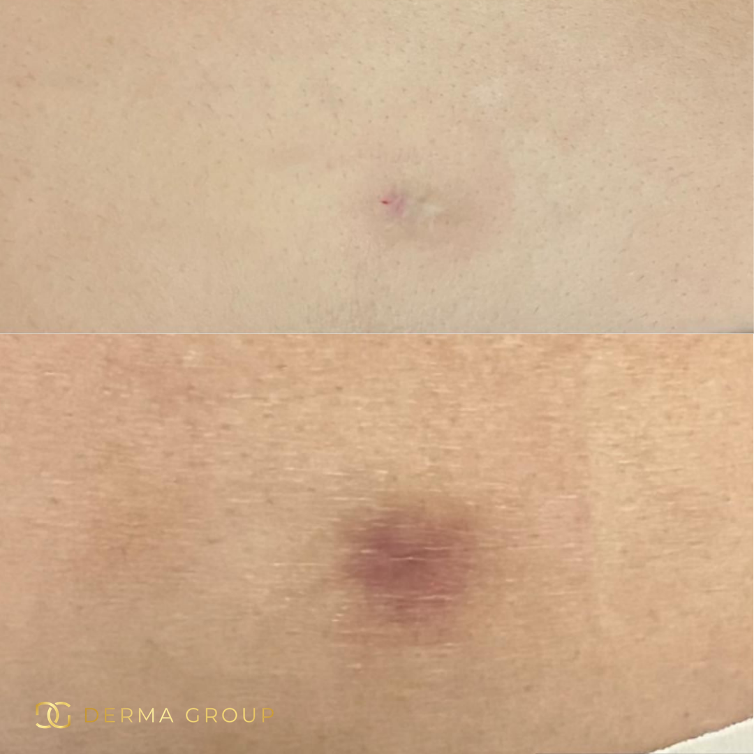 Derma Pro Fusion before and after result 3