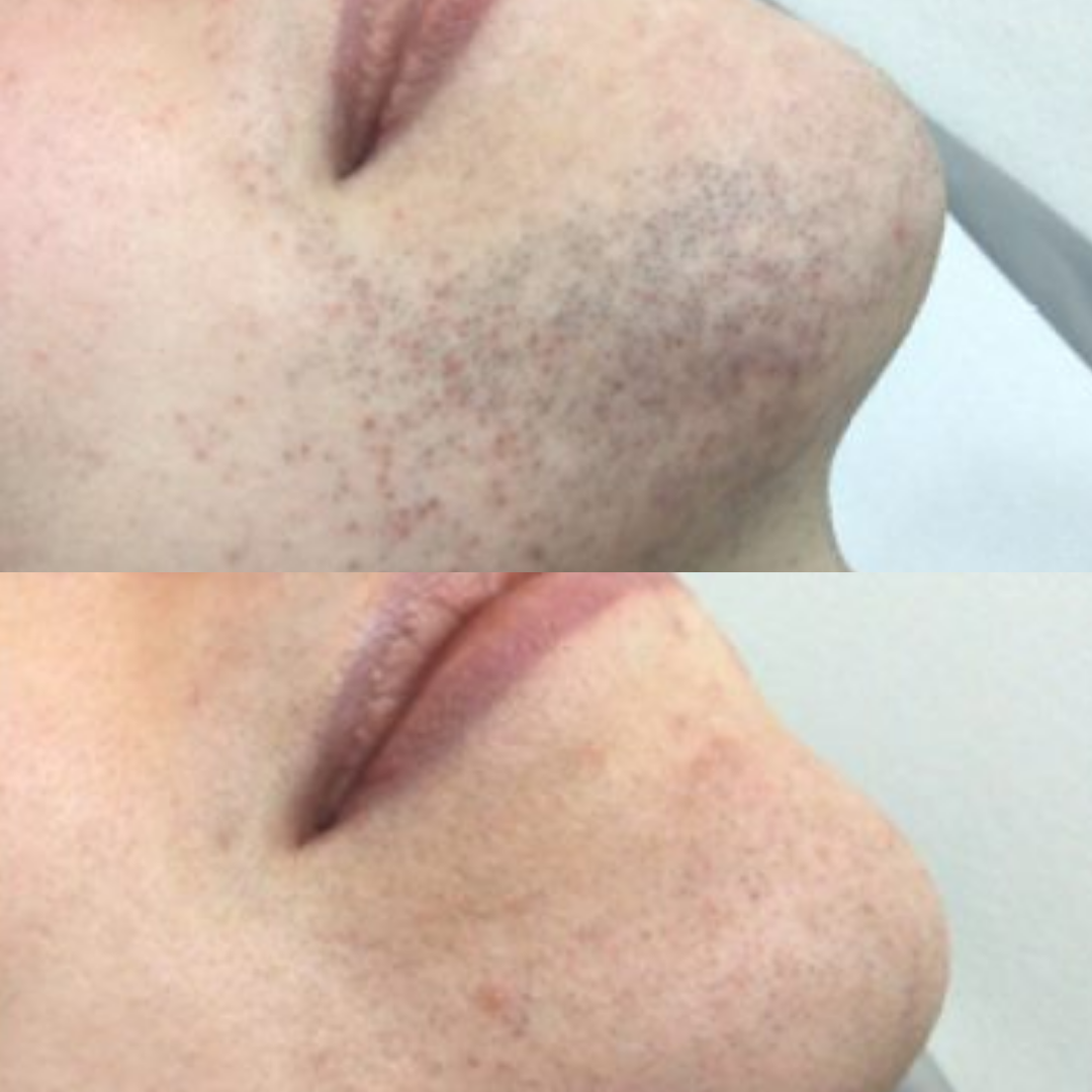 Derma Pro Fusion before and after result 2