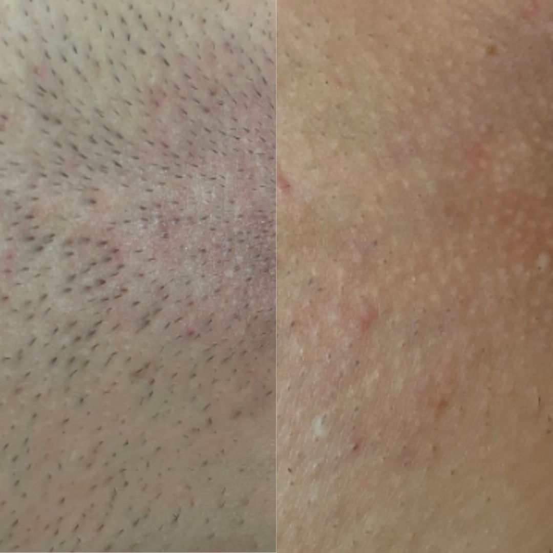 Derma Pro Fusion before and after result 1