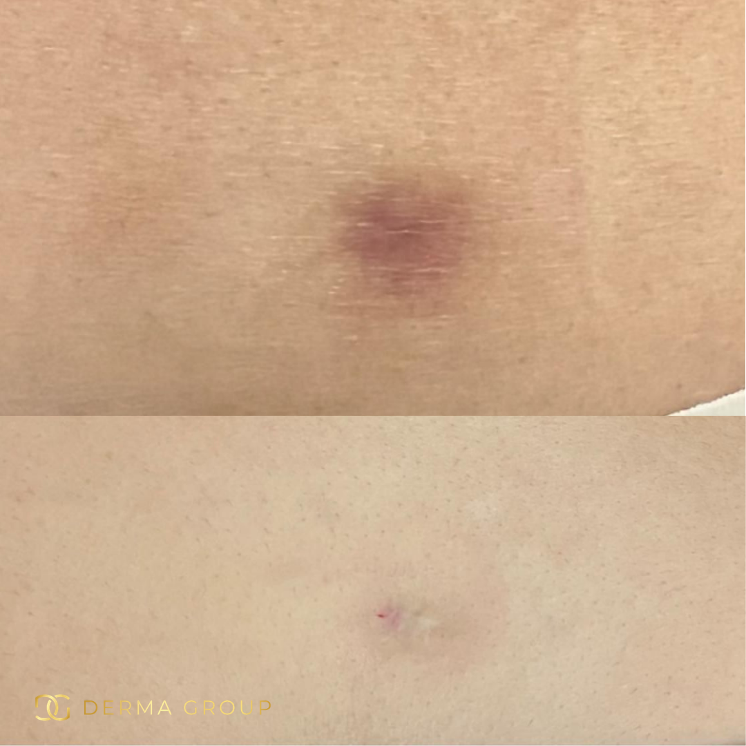 Derma Pro Fusion before and after result 3