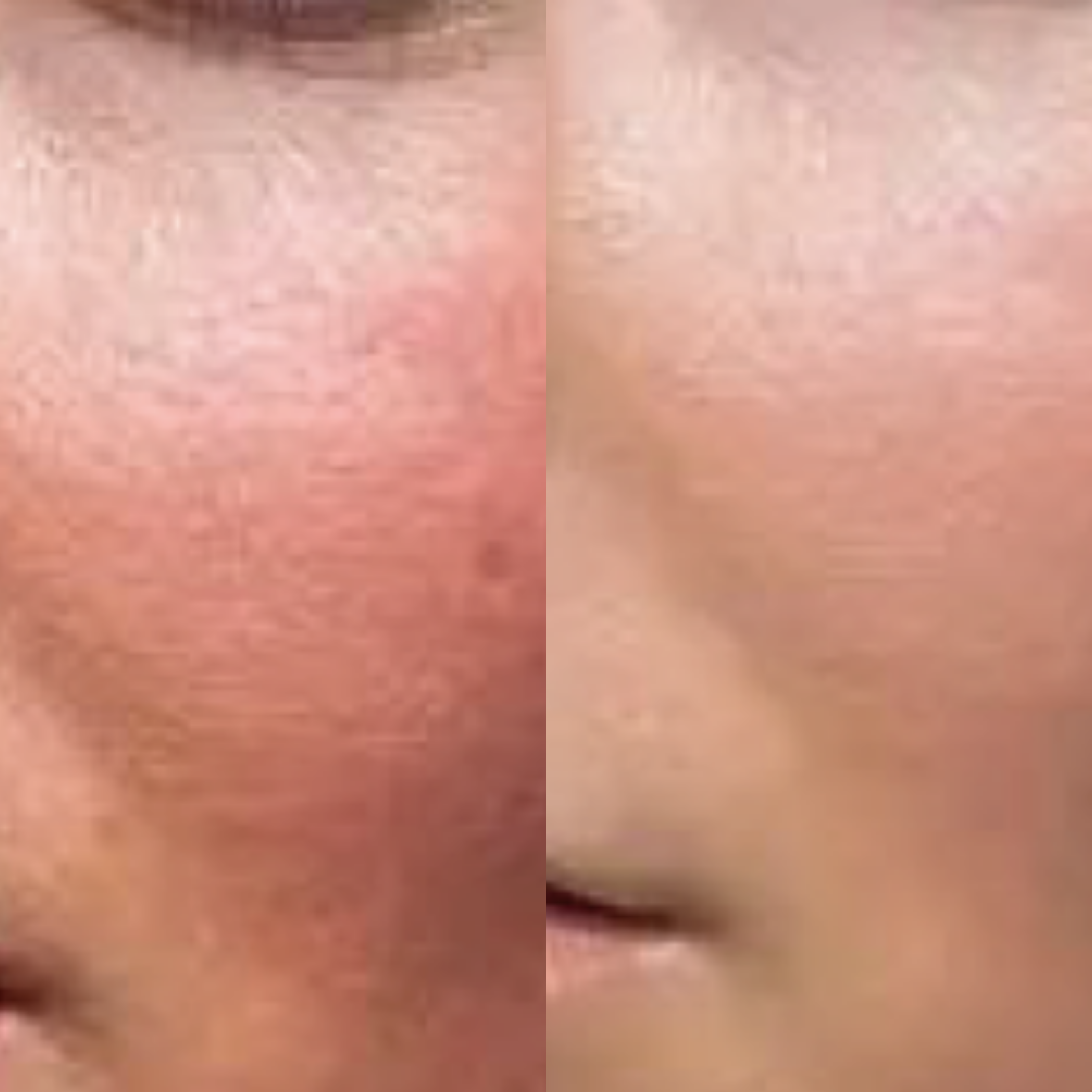 Derma Pro Fusion before and after result 4