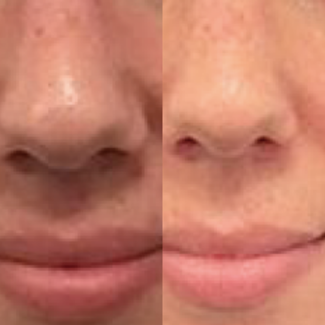 Derma Pro Fusion before and after result 4