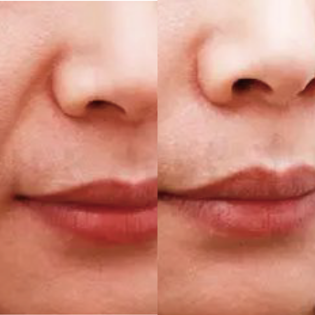 Derma Pro Fusion before and after result 4