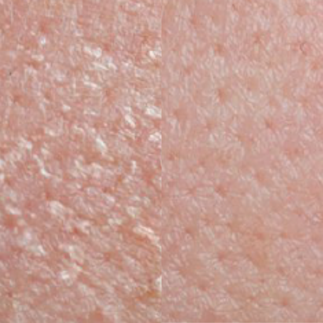 Derma Pro Fusion before and after result 4