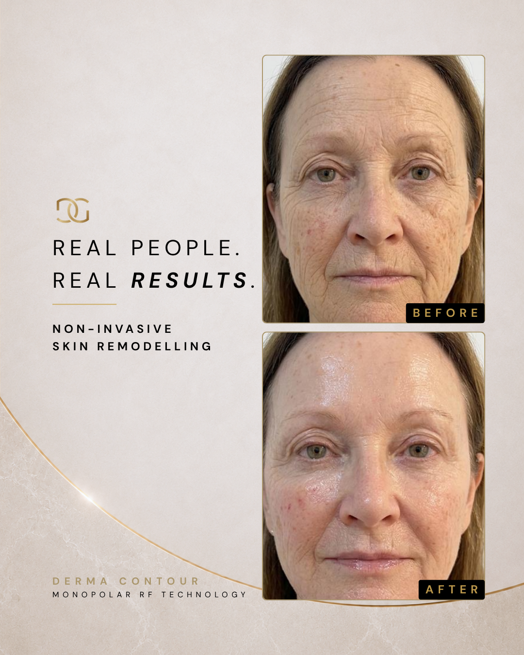 Derma Pro Fusion before and after result 2