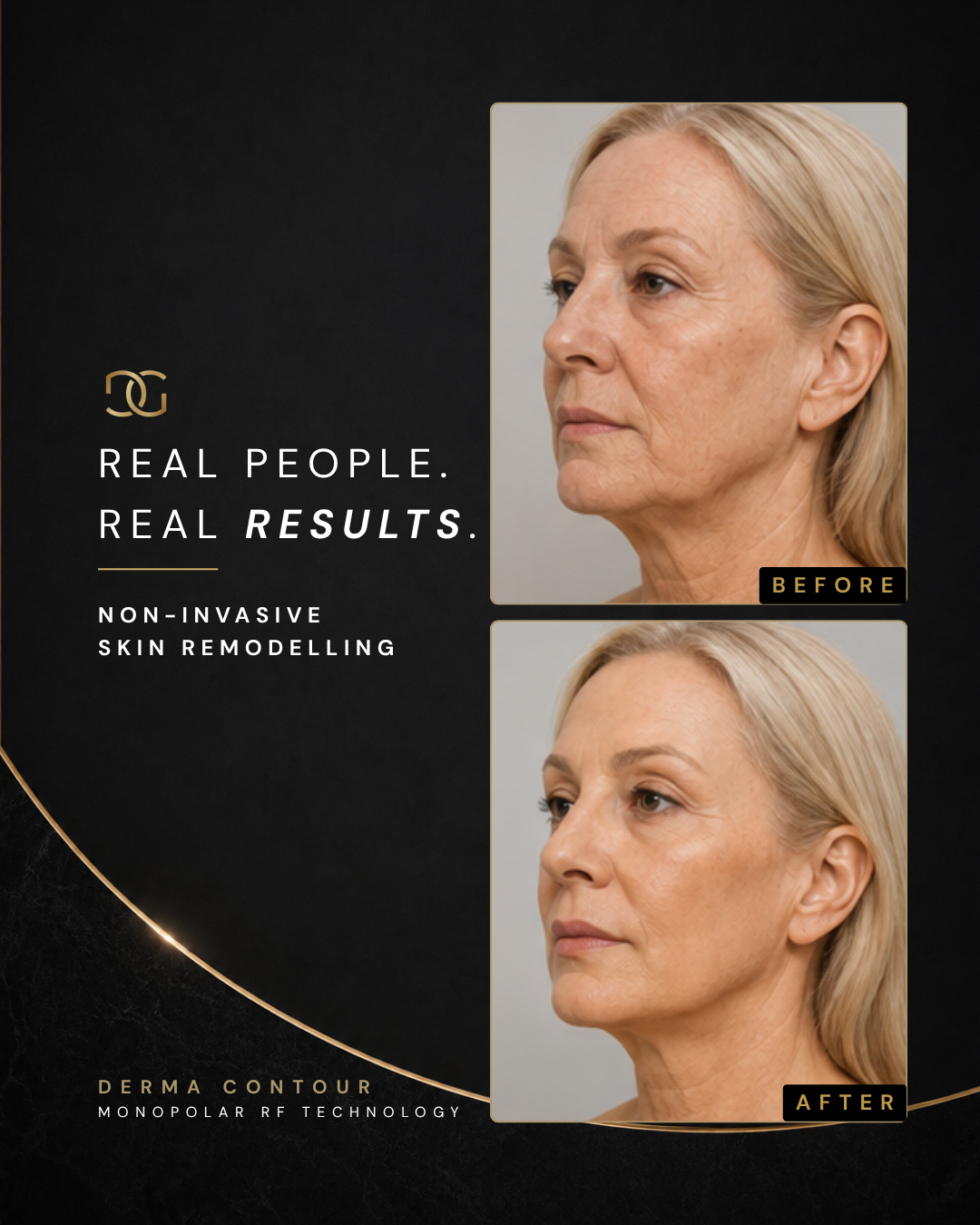Derma Pro Fusion before and after result 1