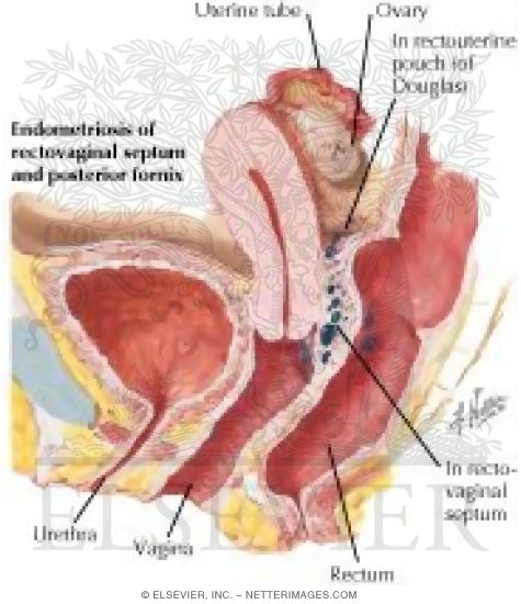 How Does Endometriosis Affect My Bowels?