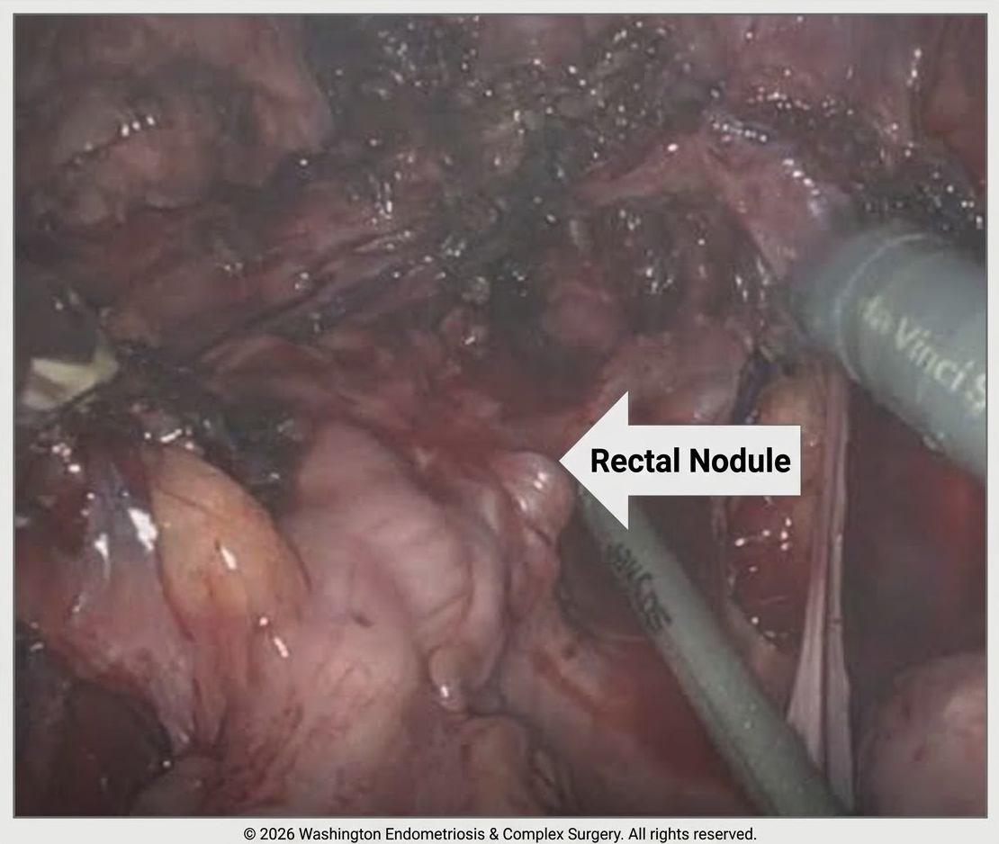 A bowel endometriosis nodule found during robotic surgery at WECS. Bowel endometriosis can cause painful bowel movements, rectal pain or pressure, constipation or diarrhea, and pelvic pain that gets worse around your period.