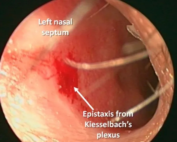 Nosebleeds (Epistaxis)