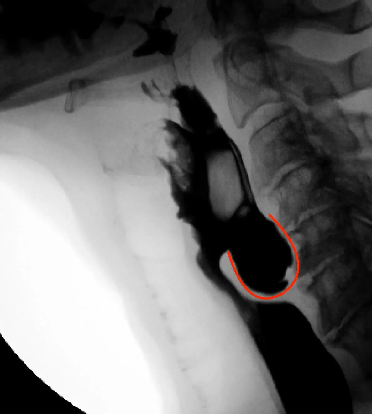 Zenker's Diverticulum