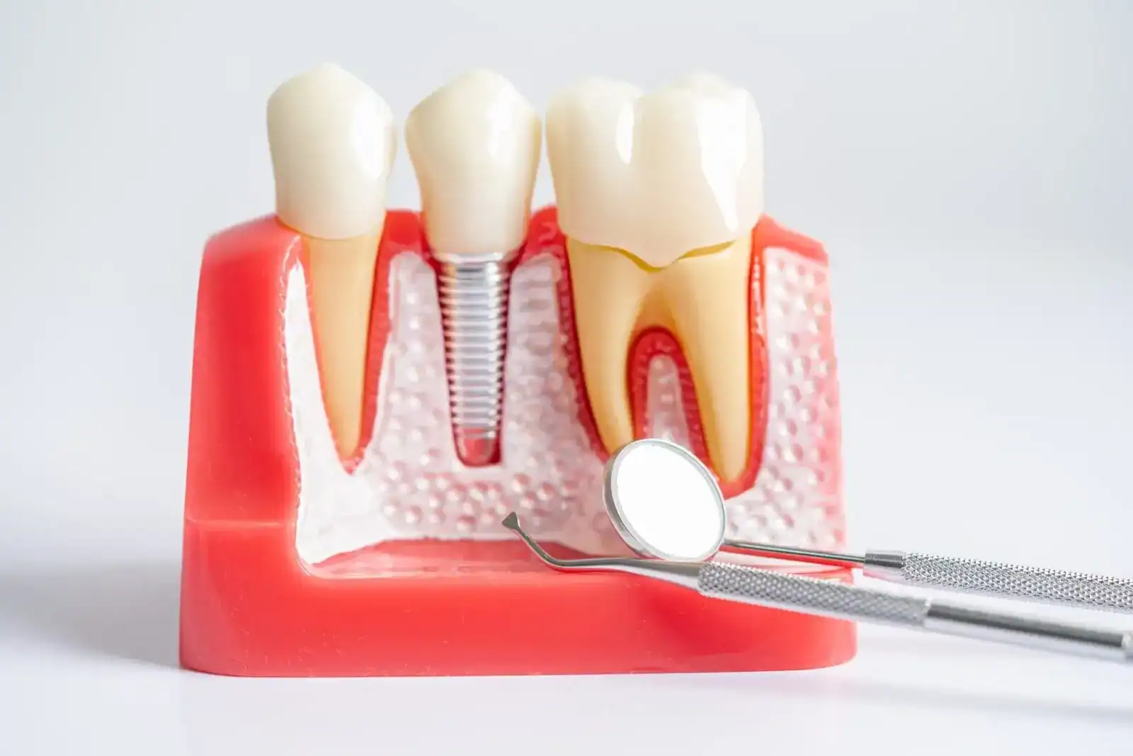 Dental implants at Dentiq Dentistry Houston