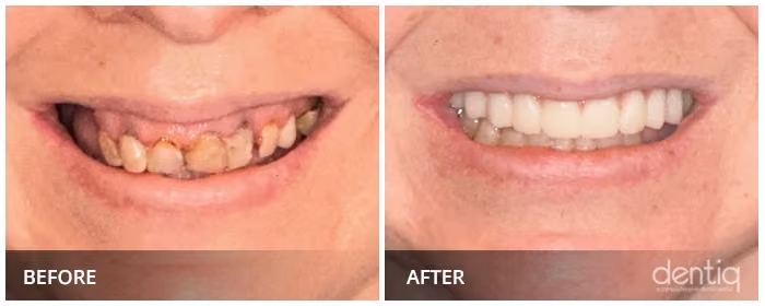 Close-up before and after All-On-4 full-arch restoration at Dentiq Dentistry Houston, case 4