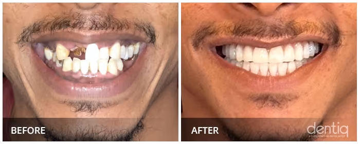 Close-up before and after All-On-4 full-arch restoration at Dentiq Dentistry Houston, case 1