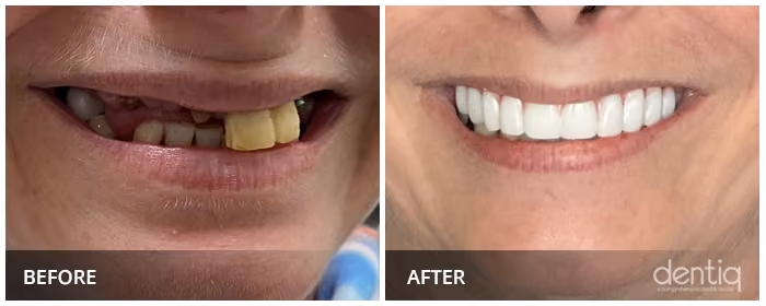 Close-up before and after All-On-4 full-arch restoration at Dentiq Dentistry Houston, case 6
