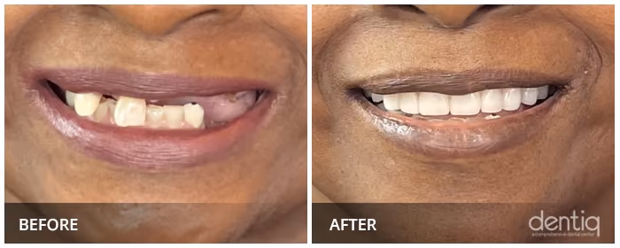 Close-up before and after All-On-4 full-arch restoration at Dentiq Dentistry Houston, case 3