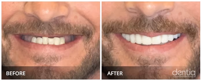 Close-up before and after All-On-4 full-arch restoration at Dentiq Dentistry Houston, case 5