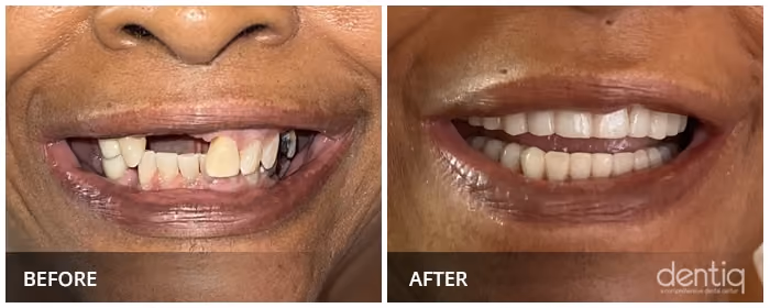 Close-up before and after All-On-4 full-arch restoration at Dentiq Dentistry Houston, case 2