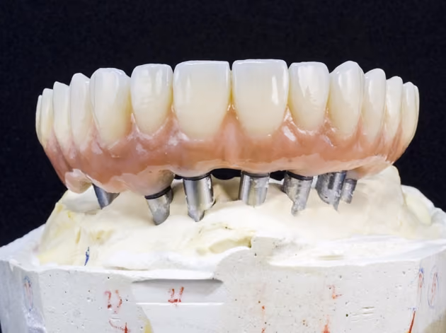 Implant-supported denture model at Dentiq Dentistry Houston