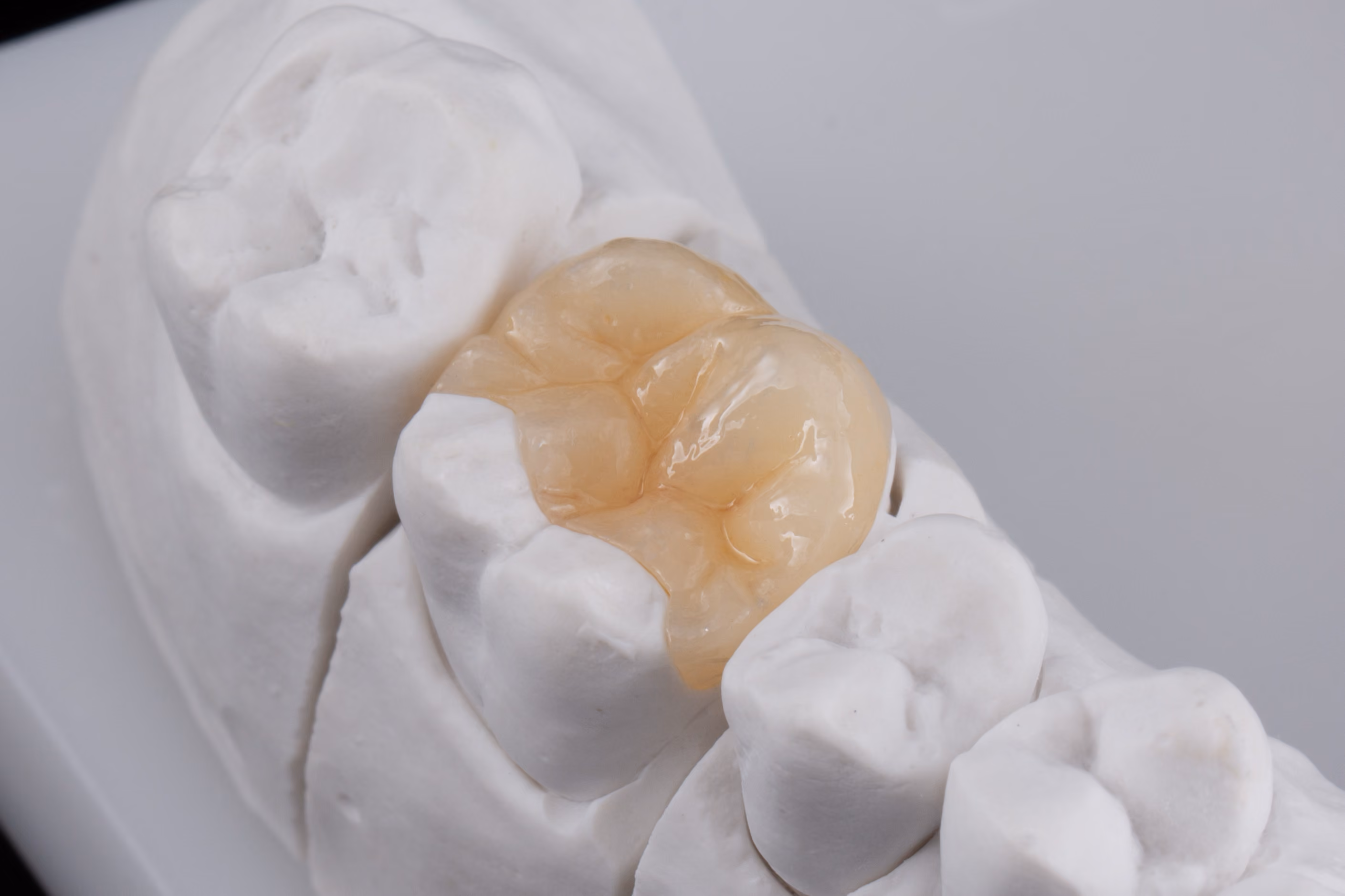 Custom porcelain onlay covering the biting surface of a repaired molar