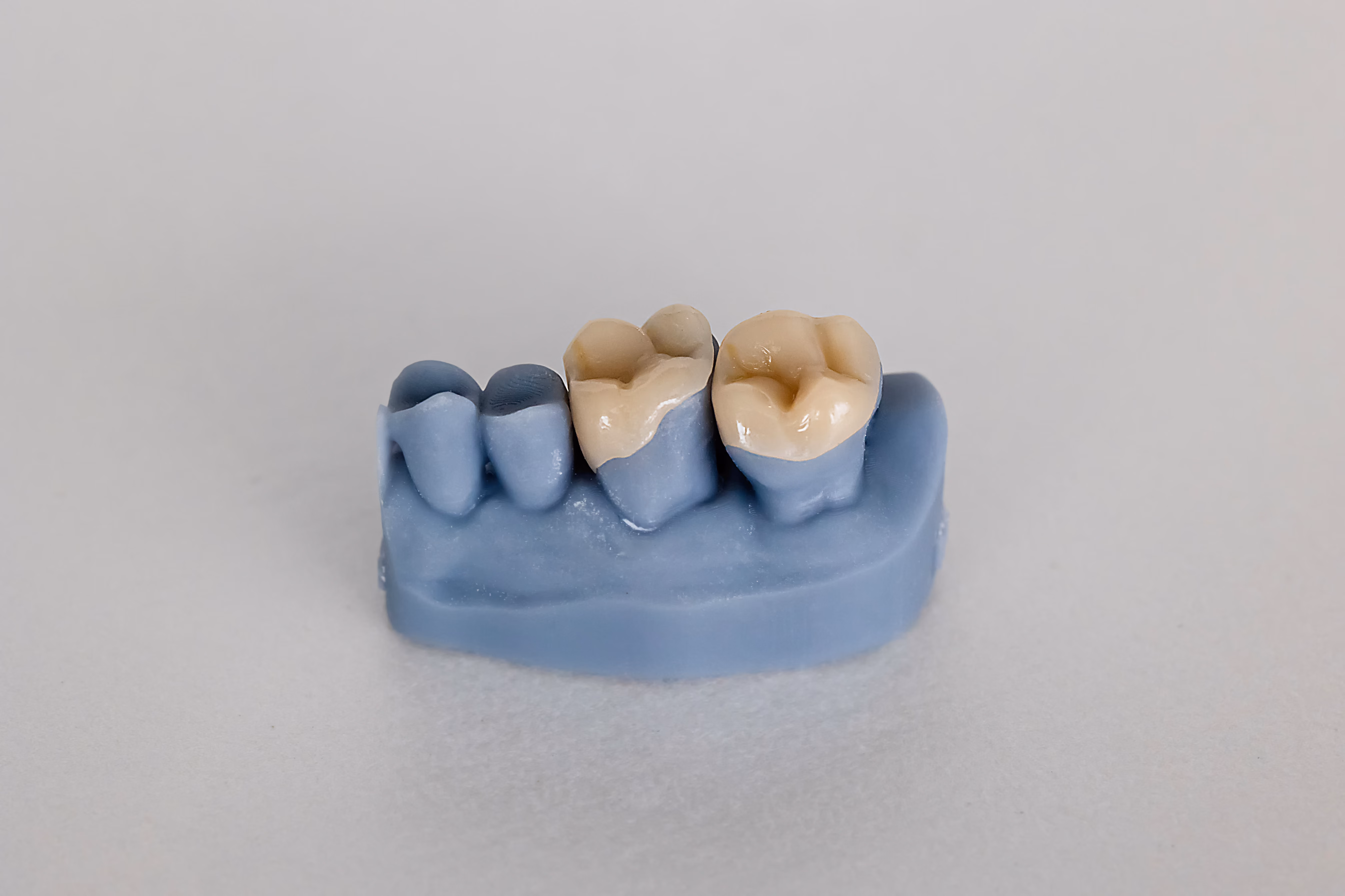 Patient smiling after inlay and onlay treatment at Dentiq Dentistry in Houston, TX