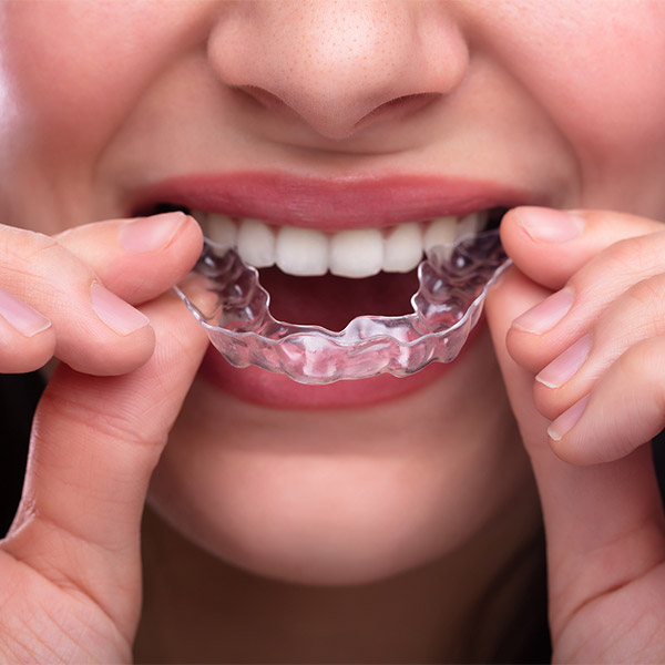 Clear CandidPro aligner tray for discreet teeth straightening