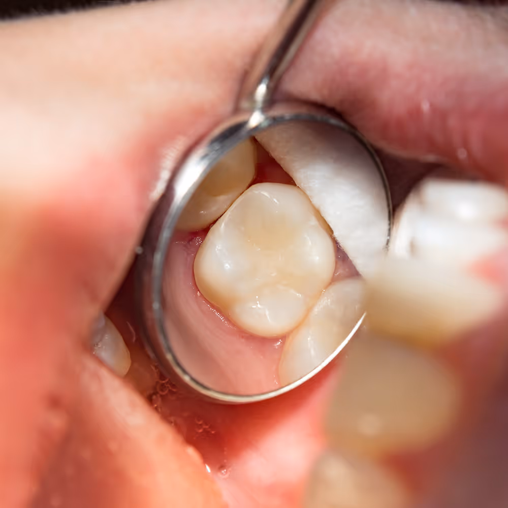 Close-up of a composite filling shade-matched to a natural tooth