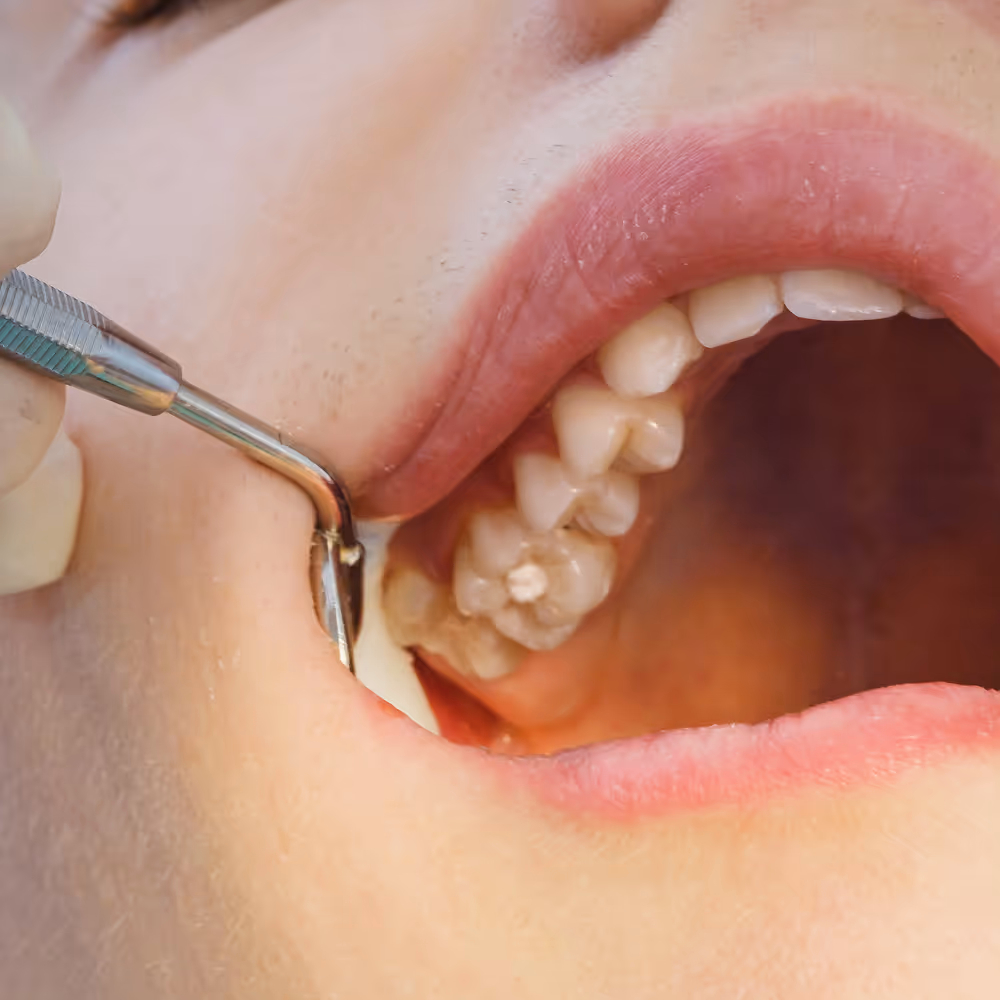 Clear protective sealant coating the grooves on the chewing surface of a molar