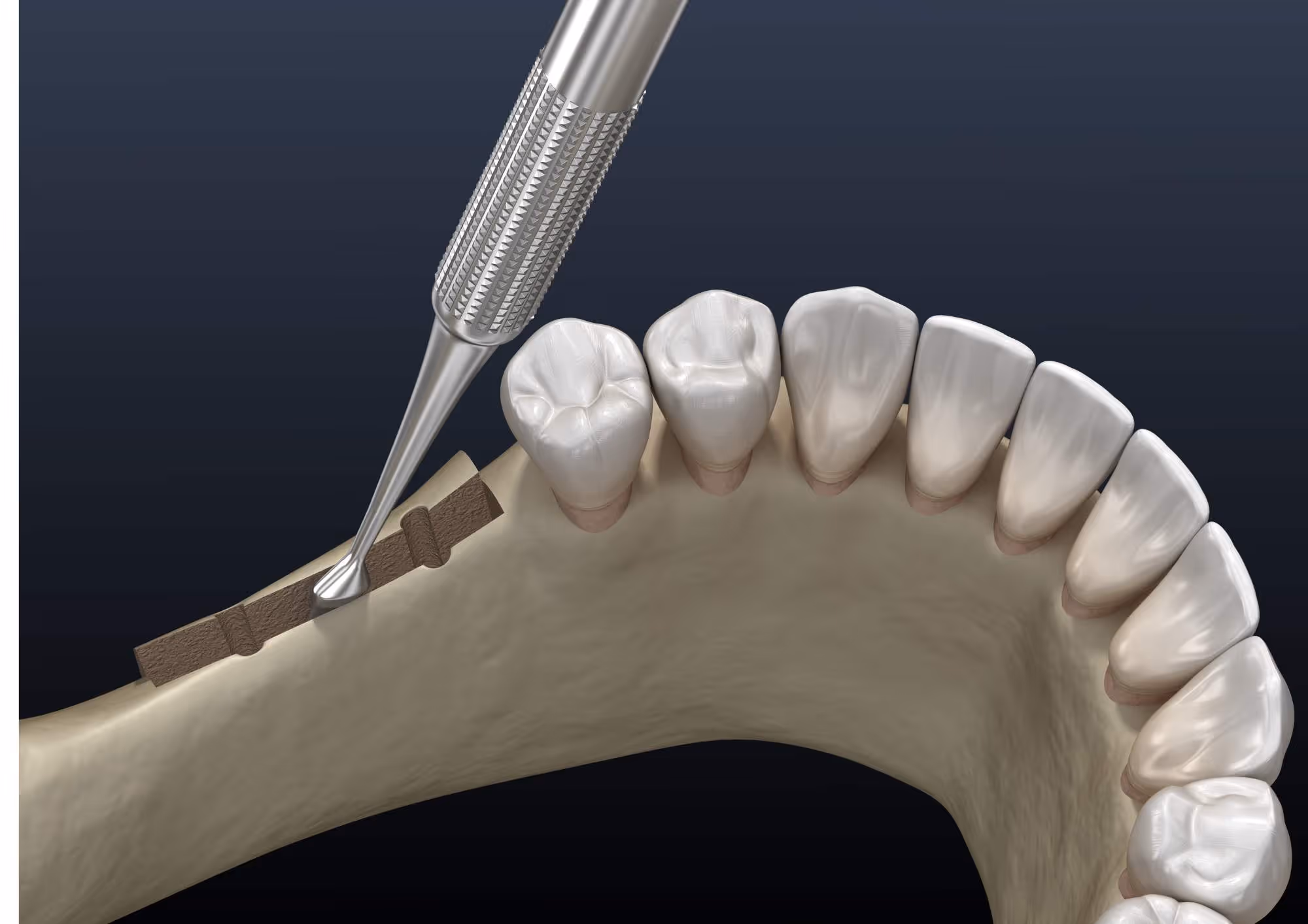 Diagram showing jawbone ridge rebuilt with a graft after tooth extraction