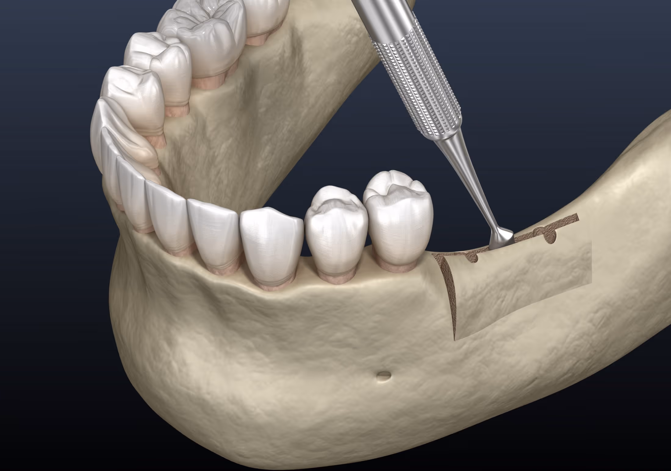 Ridge augmentation consultation at Dentiq Dentistry in Houston, TX