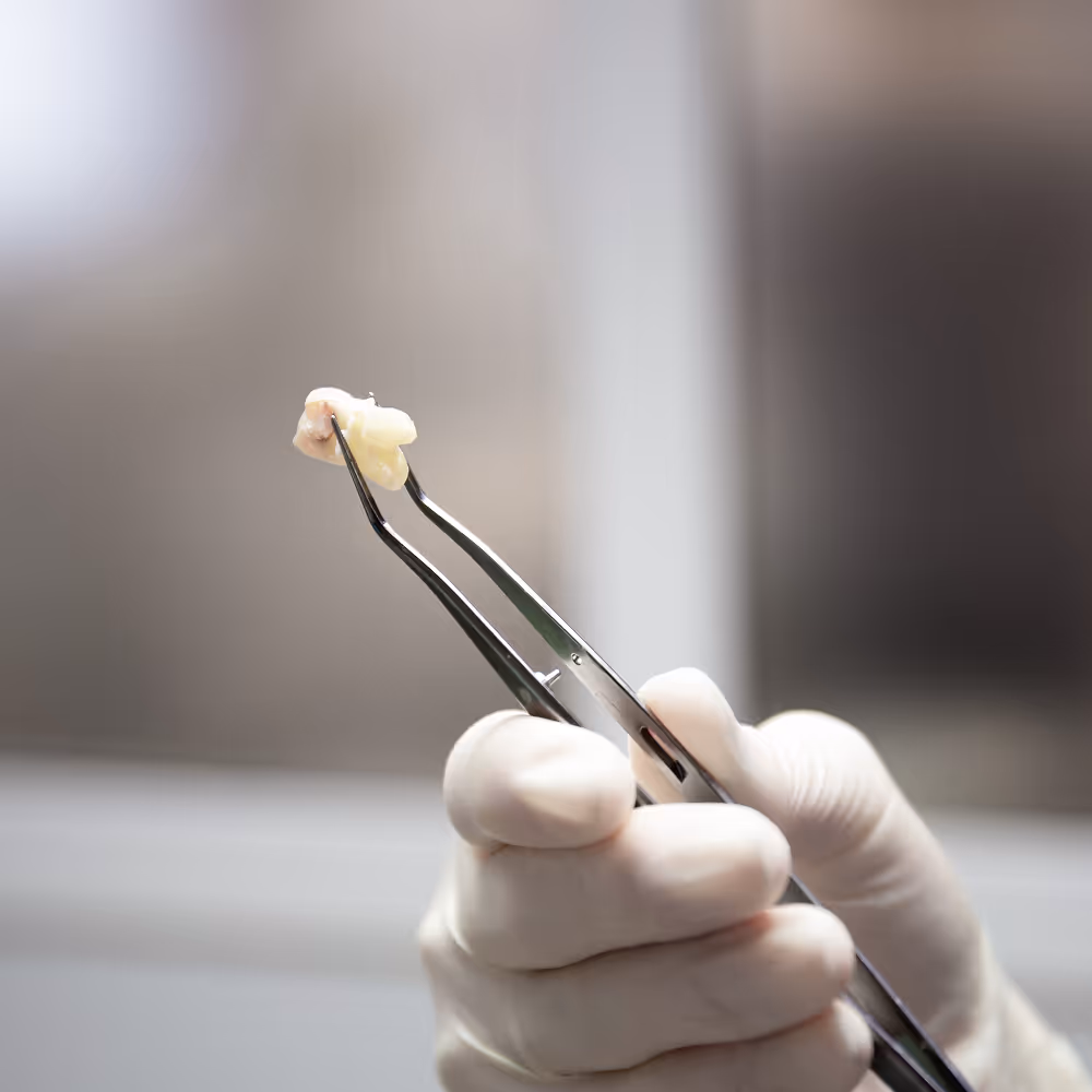 Dental X-ray showing an impacted wisdom tooth pressing against a neighboring molar